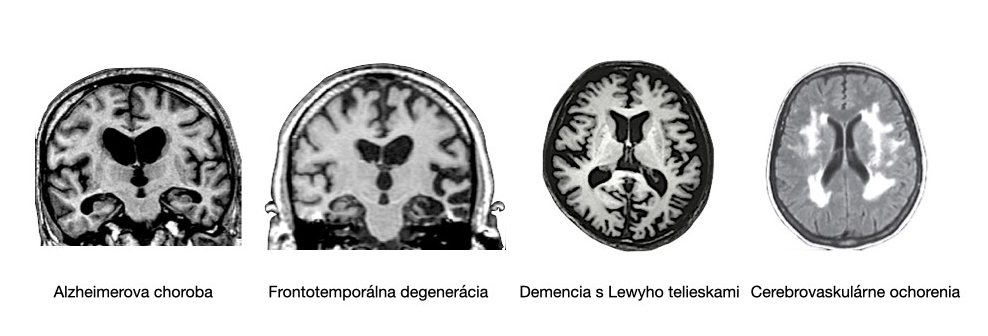 Na obrázku sú 4 snímky s typickými nálezmi MRI pri Alzheimerovej chorobe, frontotemporálnej degenerácii, demencii s Lewyho telieskami a cerebrovaskulárnom ochorení.