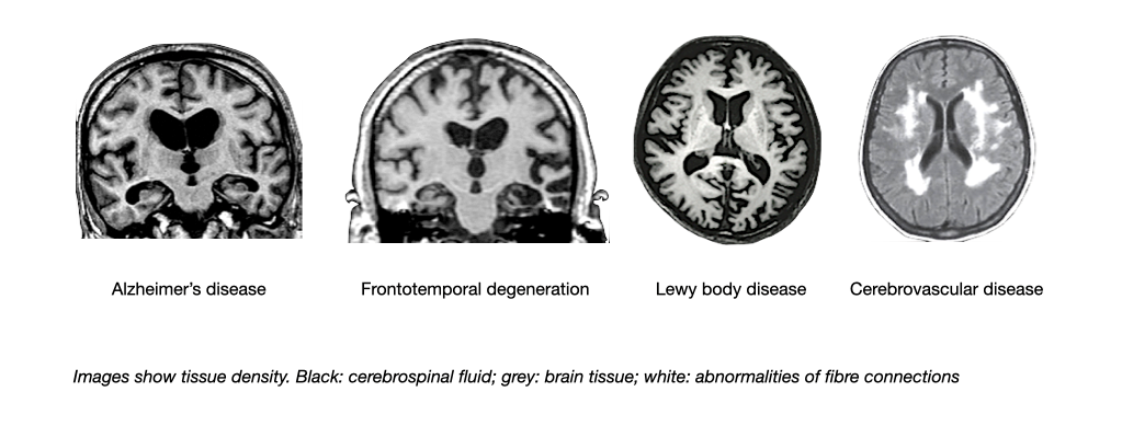 The picture shows 4 images with typical MRI findings in Alzheimer's disease, frontotemporal degeneration, Lewy body disease and cerebrovascular disease. 