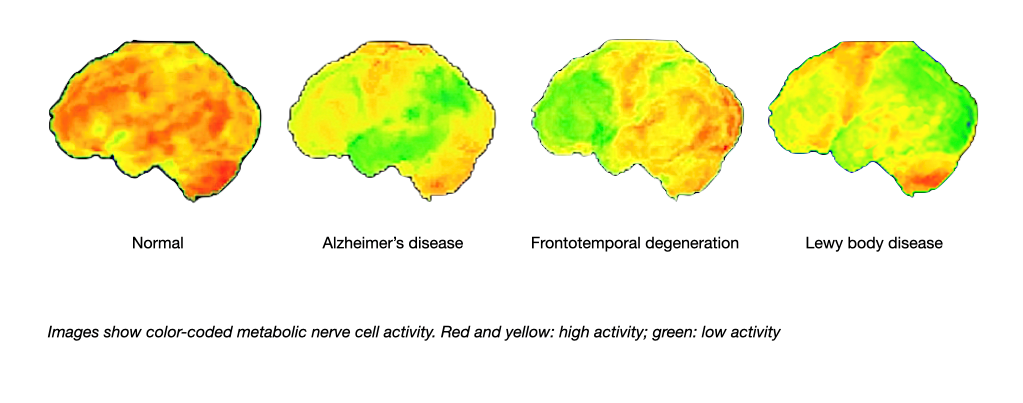 These images show typical positron emission tomography findings in Alzheimer's disease, frontotemporal degeneration and Lewy body disease compared to a normal finding.