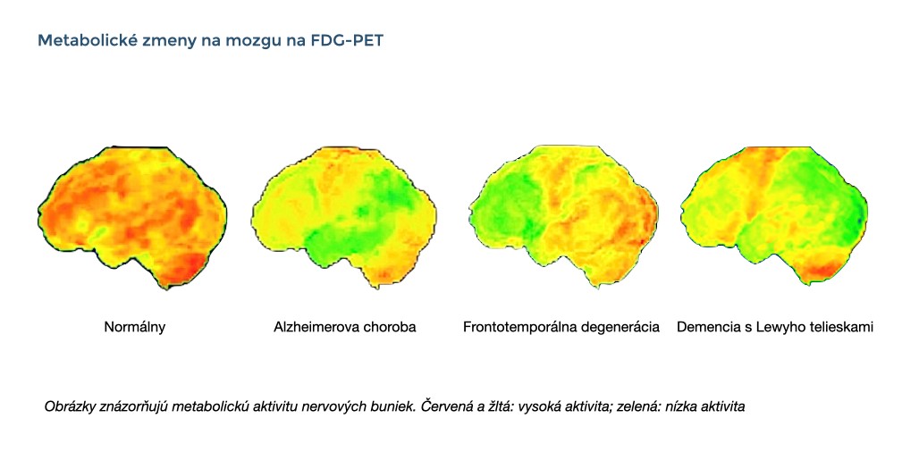 Tieto snímky ukazujú typické nálezy pozitrónovej emisnej tomografie pri Alzheimerovej chorobe, frontotemporálnej degenerácii a demencii s Lewyho telieskami v porovnaní s normálnym nálezom.